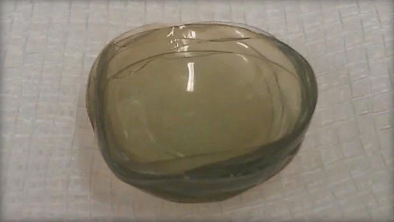 Doctors Find 27 Contact Lenses In Woman's Eye