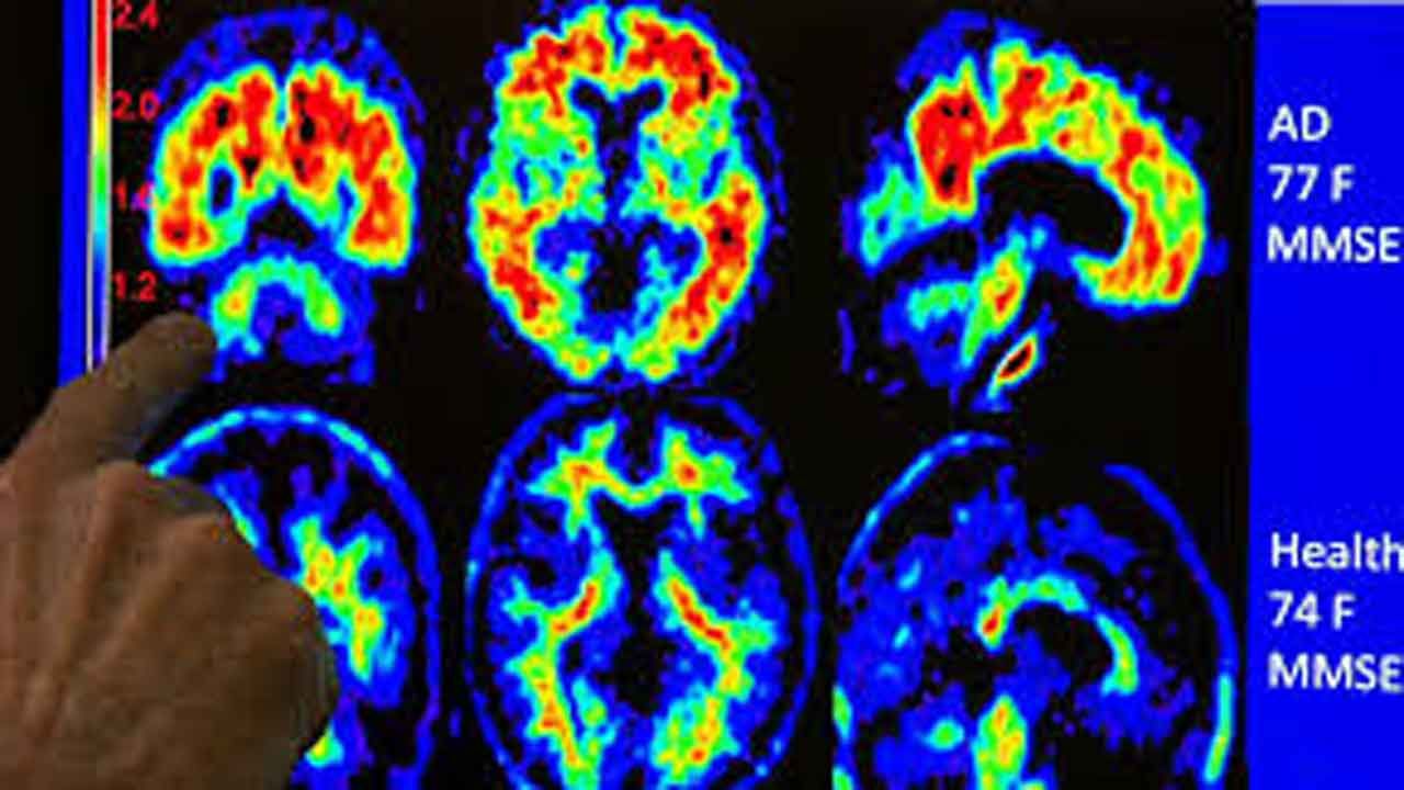 One-Third Of Dementia Cases Could Be Prevented, Report Says