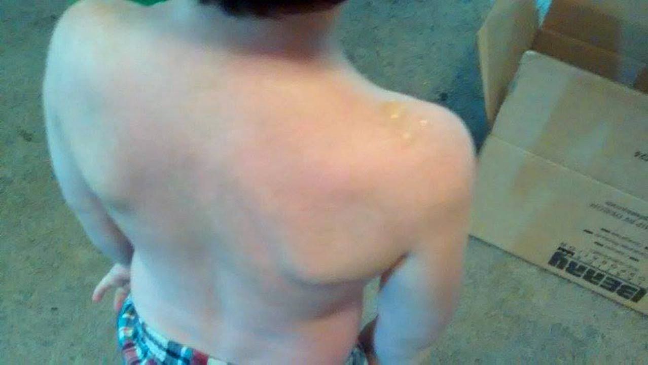 Mother: Two Vinita Boys Severely Sunburned During Daycare Trip