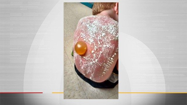 GRAPHIC: Mother Says Two Vinita Boys Severely Sunburned On Daycare Trip
