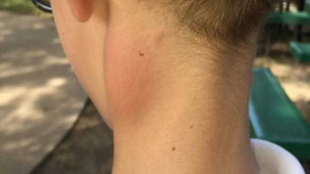 Oklahoma Doctors Seeing 'Mite Bite Outbreak'